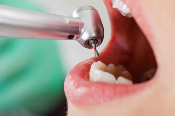Best Emergency Wisdom Teeth Removal in Biscayne Park, FL